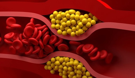 Povišan holesterol škodi erekciji